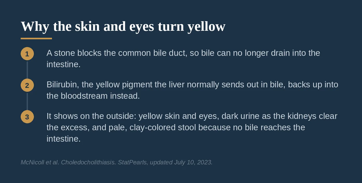 Diagram tracing a blocked bile duct to yellow skin and eyes, dark urine, and pale stool.
