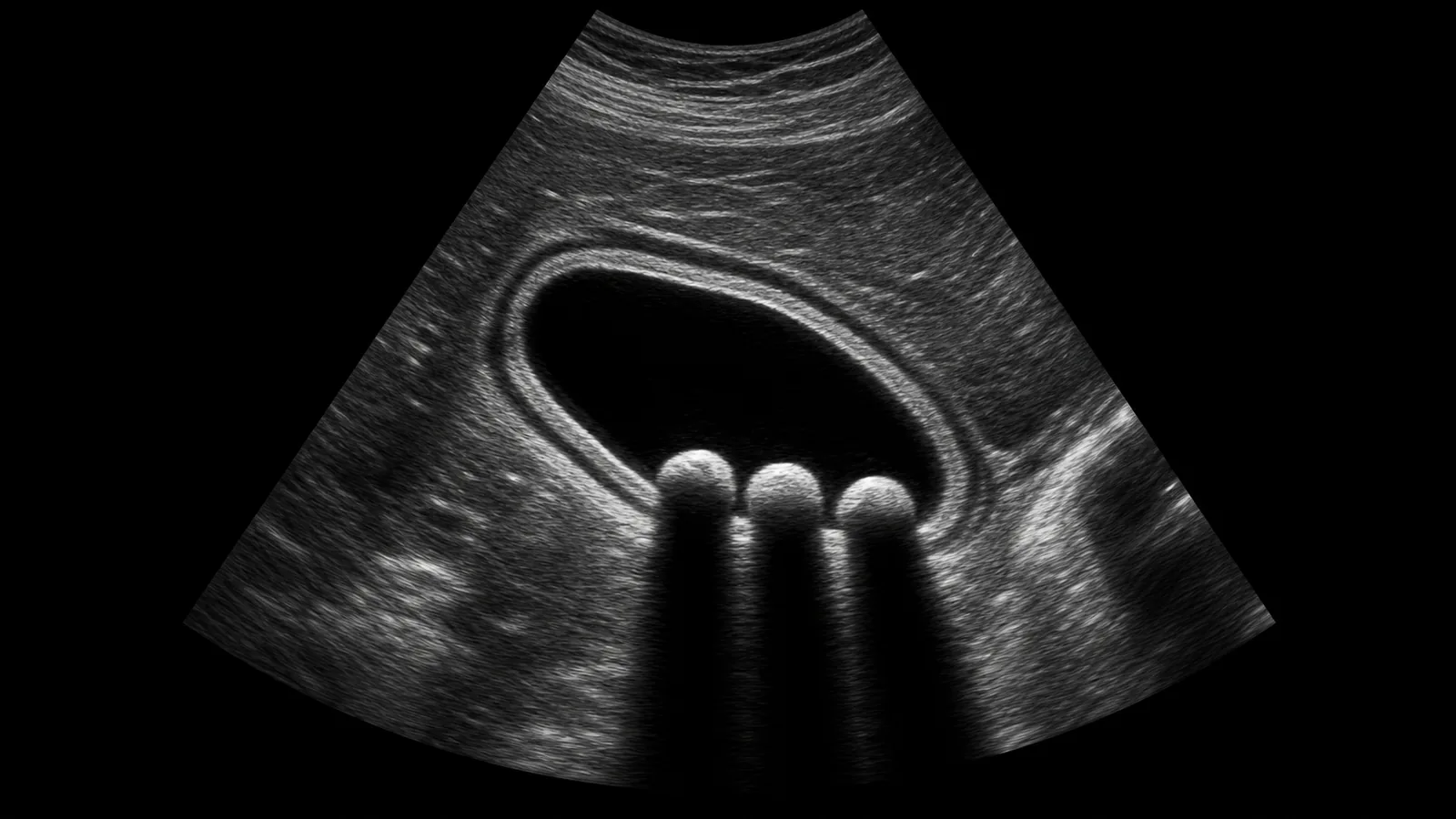 A grayscale ultrasound image showing a dark gallbladder containing three bright gallstones, each casting a black shadow downward.