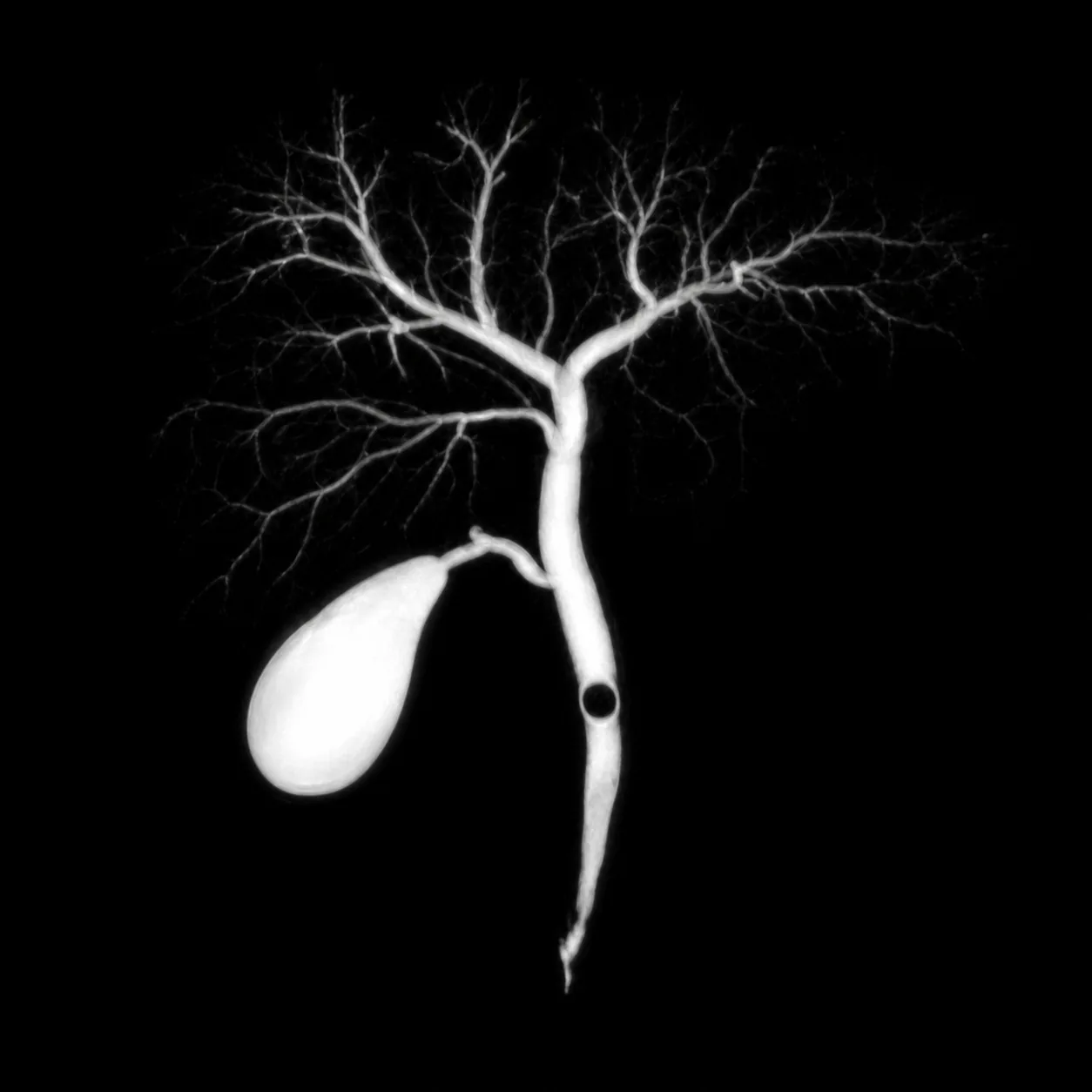 An MRCP image showing the bile ducts as a bright branching tree on a black background, with a dark round gap in the main duct.