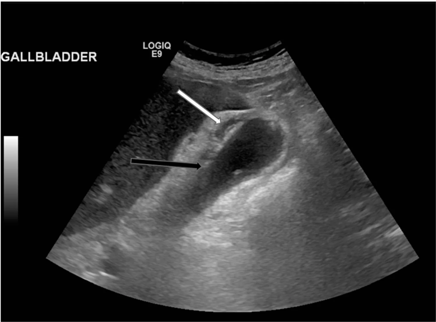 Sagittal ultrasound of a gallbladder containing bright gallstones, with a thickened wall and a rim of fluid outside it.