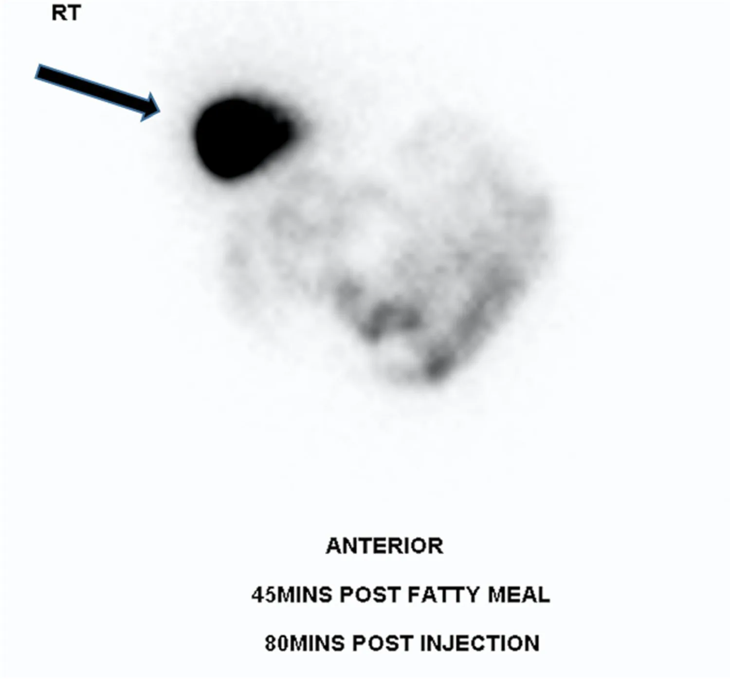 A normal HIDA scan showing the tracer collected in the gallbladder as a dark rounded area.