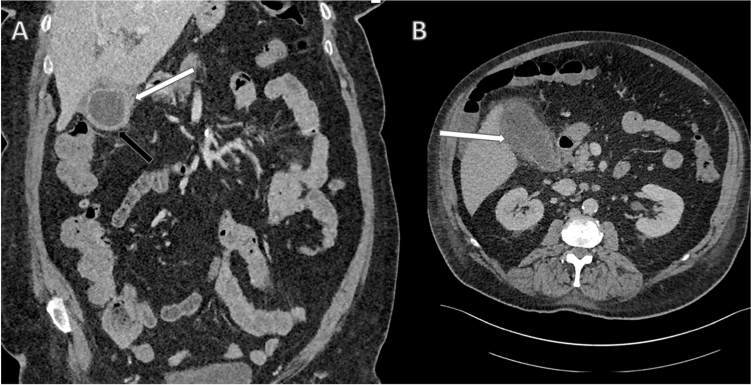 Coronal and axial contrast-enhanced CT showing a thickened gallbladder wall with fluid around it.