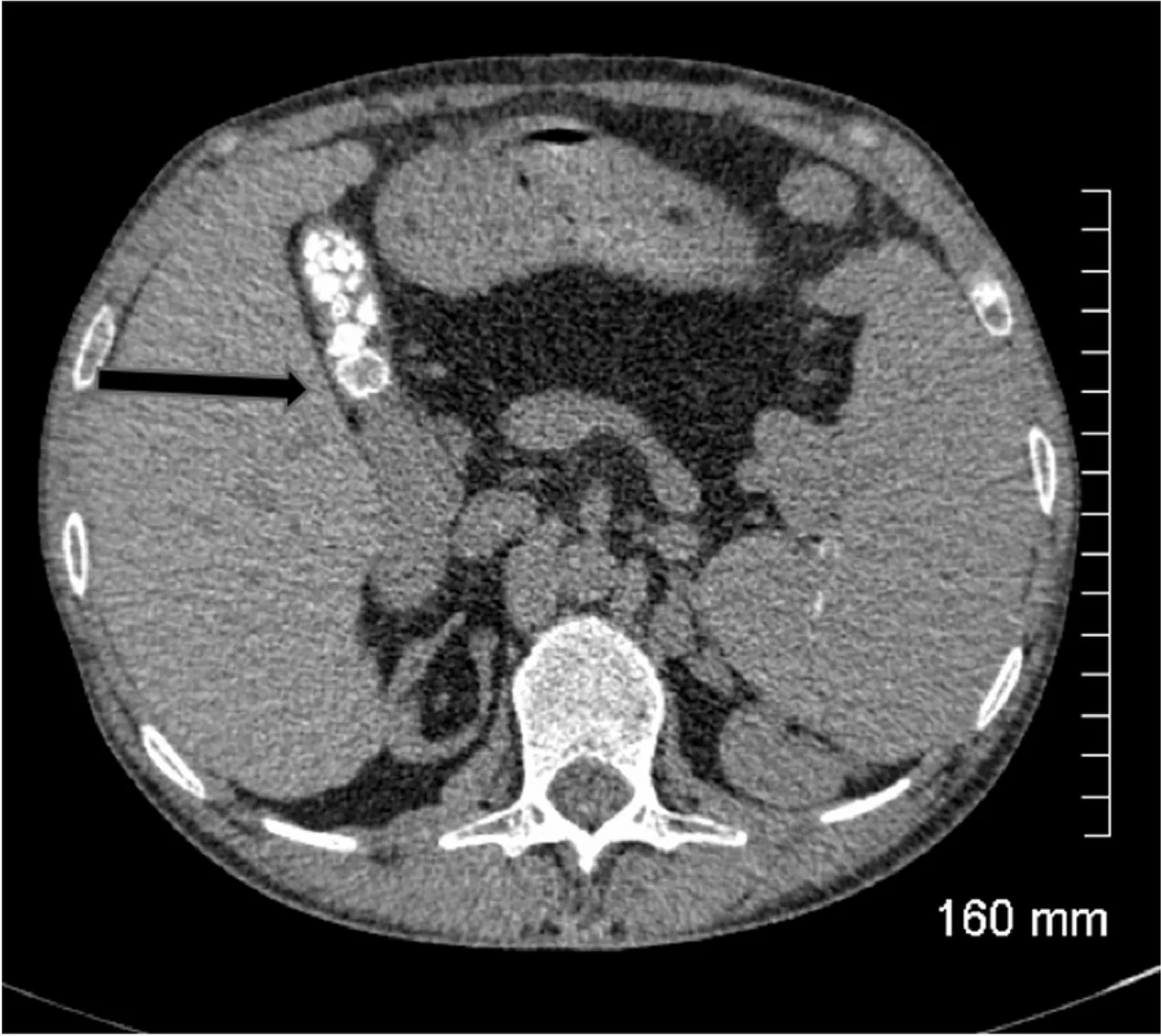 Axial contrast-enhanced CT showing several bright calcified gallstones inside the gallbladder.