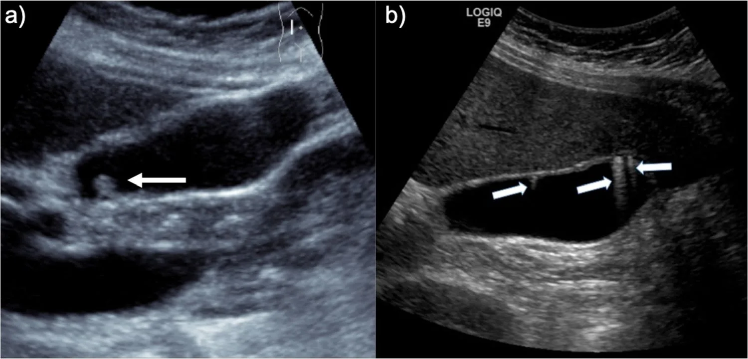 Two ultrasound images side by side. On the left, an arrow points to a true gallbladder polyp attached to the wall with no shadow behind it. On the right, arrows point to bright trailing streaks behind small wall lesions, the comet tail artifact of cholesterol deposits.