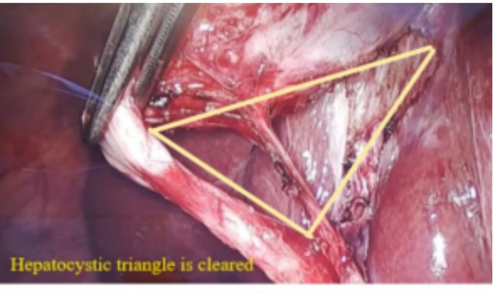 The first component of the critical view of safety: all of the fatty tissue cleared out of the hepatocystic triangle, the space bounded by the gallbladder, the liver edge and the duct below.