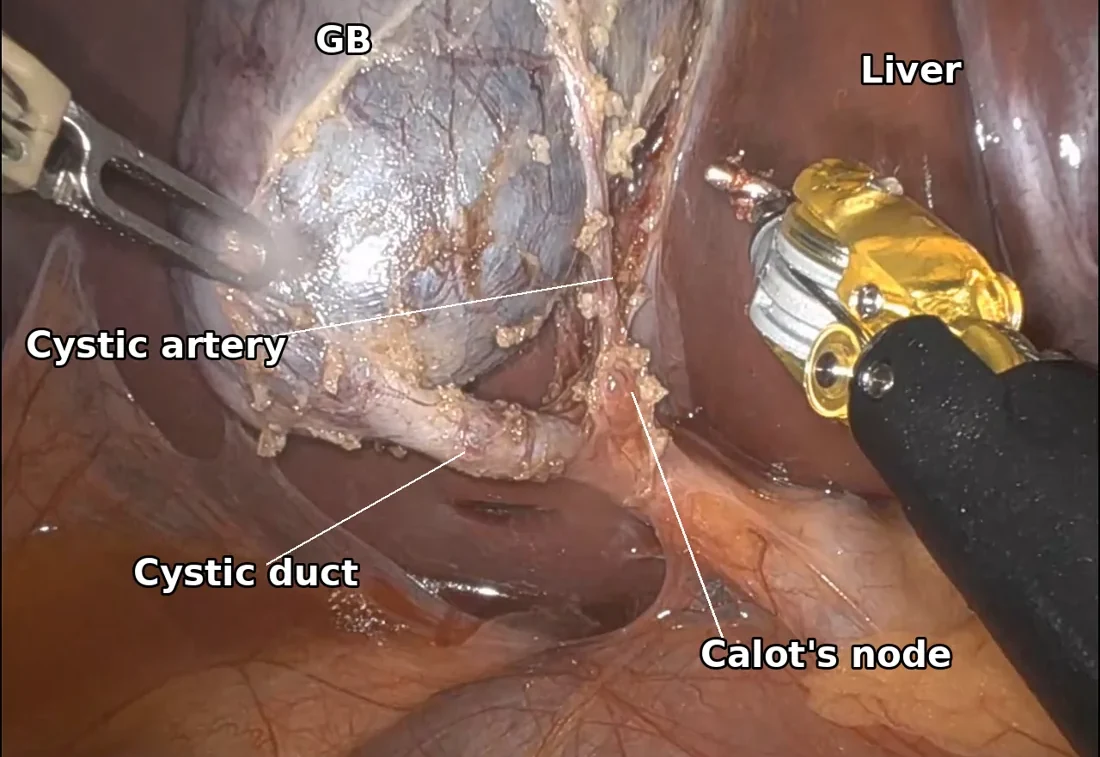 The second component of the critical view of safety: exactly two tubular structures seen entering the gallbladder, the cystic duct and the cystic artery, with nothing else crossing into it.