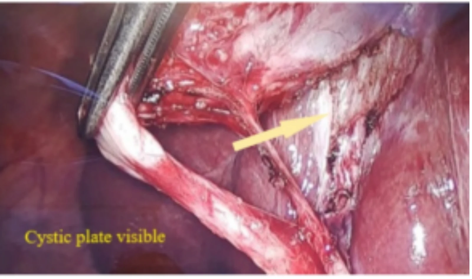 The third component of the critical view of safety: the lower third of the gallbladder dissected off the cystic plate on the liver bed, so the back of it can be seen.