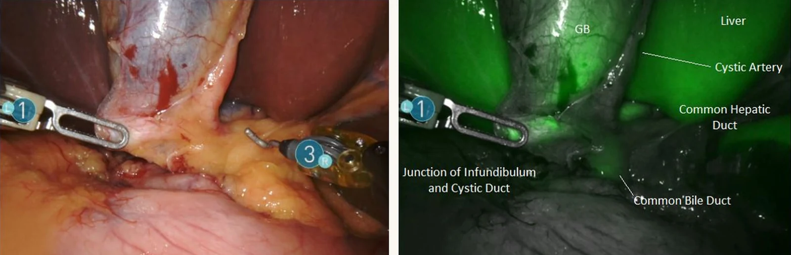 Two operative views side by side of the same anatomy. On the left, white light: an instrument holds the bottom of the gallbladder and the cystic duct runs off it toward the center of the frame, where it joins the common hepatic duct to form the common bile duct. On the right, near-infrared fluorescence: the same ducts glowing bright green.