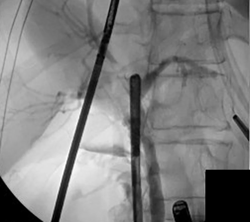 An intraoperative cholangiogram: an X-ray taken on the operating table showing the branching bile duct tree filled with contrast, down to where it enters the intestine.
