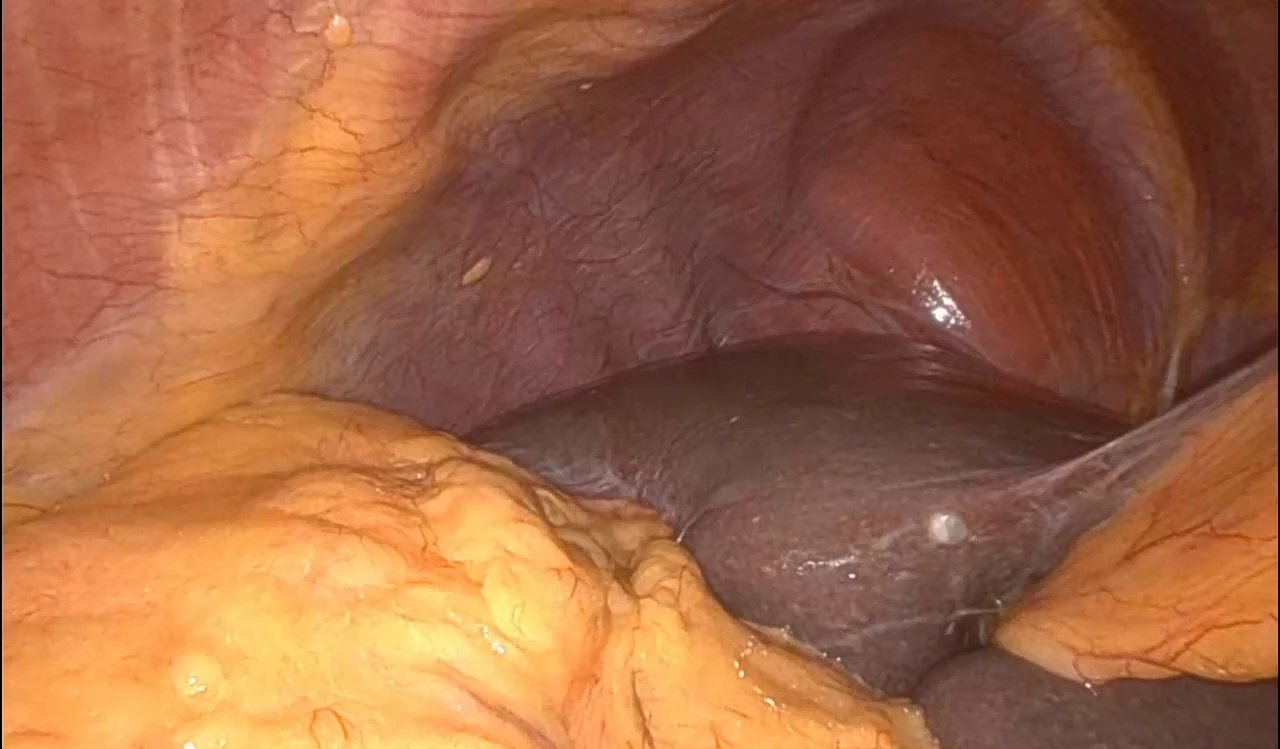 Operative view at the start of a difficult case: the dome of the gallbladder is completely covered by omentum, the fatty apron of the abdomen, which has wrapped over it and sealed it down. No part of the gallbladder is visible.