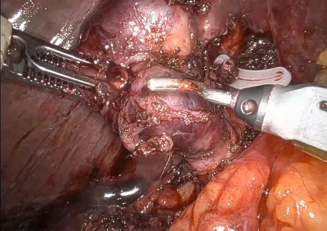 Operative view in the same case after the omentum was taken down: the dissection is carried into the space between the gallbladder, the liver and the ducts, with instruments working on the structures running to the gallbladder.