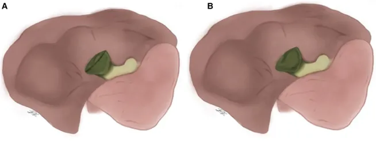 Two panels comparing the subtypes of subtotal cholecystectomy. Panel A, the reconstituting type: the lower end of the gallbladder is closed off, leaving a small remnant. Panel B, the fenestrating type: the gallbladder is left open.