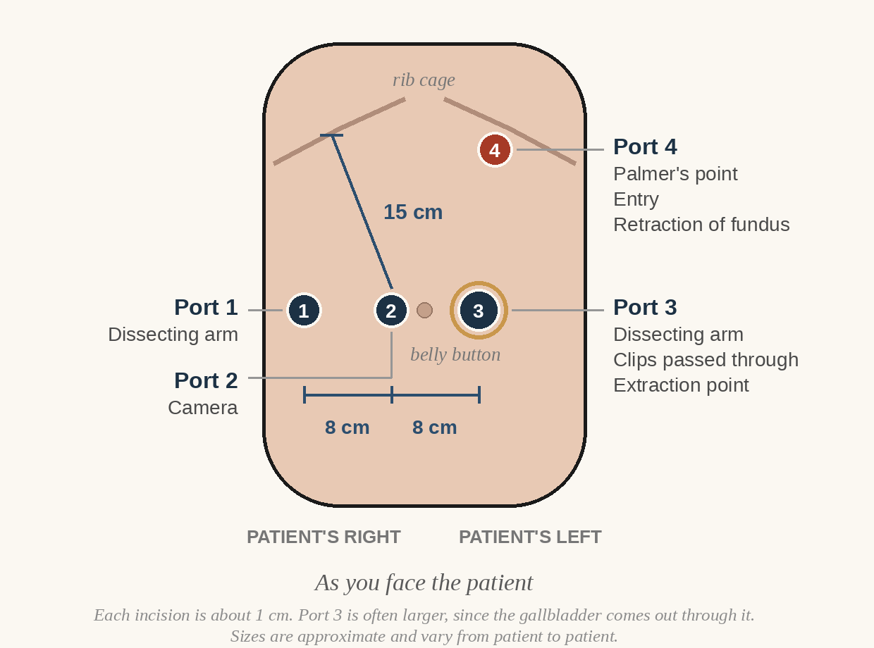 Port map for robotic cholecystectomy: Port 4 at Palmer's Point high on the patient's left; ports 1, 2 and 3 across at navel level, 8 cm apart; 15 cm from the right costal margin to the camera port.