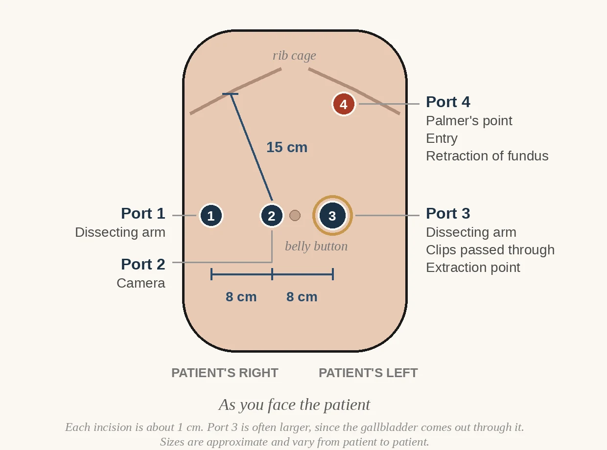 Port map for robotic cholecystectomy: Port 4 at Palmer's Point high on the patient's left; ports 1, 2 and 3 across at navel level, 8 cm apart; 15 cm from the right costal margin to the camera port.