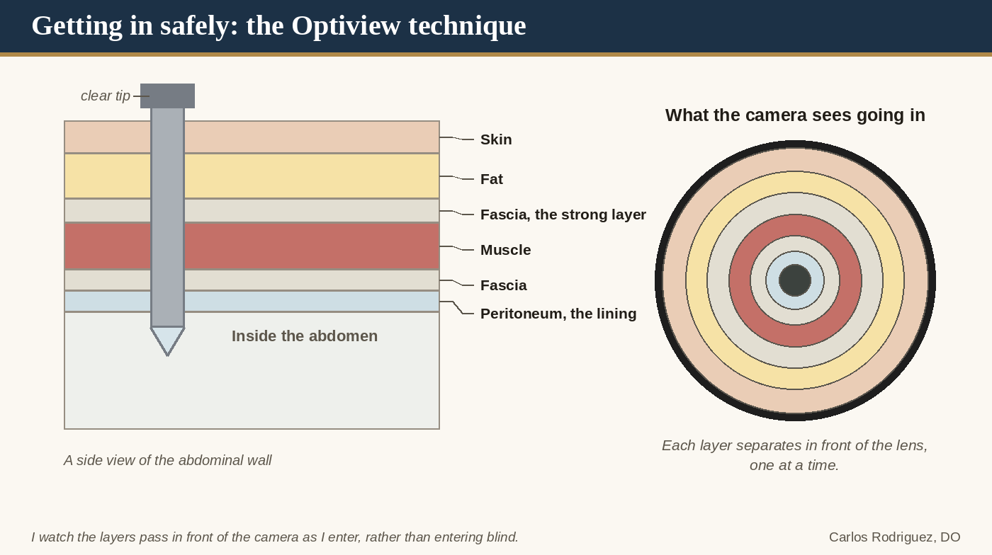 Getting in safely, the Optiview technique: a side view of the abdominal wall with a clear-tipped port passing through skin, fat, fascia, muscle, fascia and peritoneum, and what the camera sees going in, each layer separating in front of the lens one at a time.