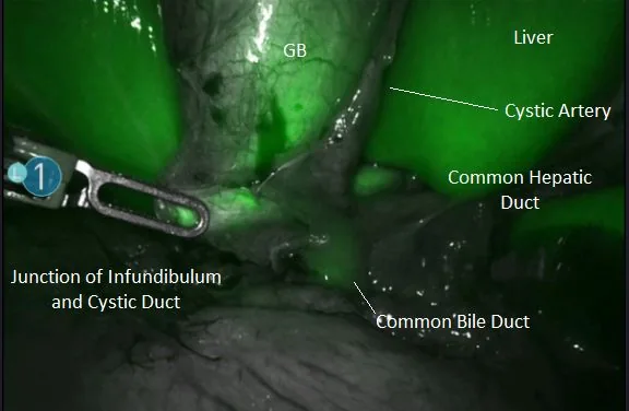Operative view under fluorescence imaging: the gallbladder, cystic artery, common hepatic duct and common bile duct labeled, with the bile ducts glowing green.