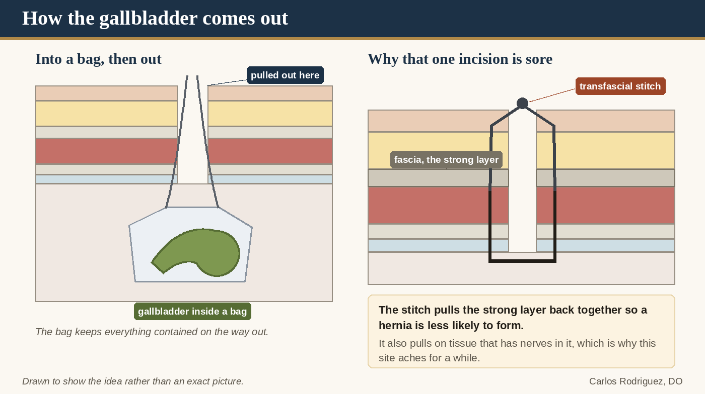 How the gallbladder comes out: the bag pulled up through the abdominal wall, and the transfascial stitch that closes the strong layer so a hernia is less likely to form.