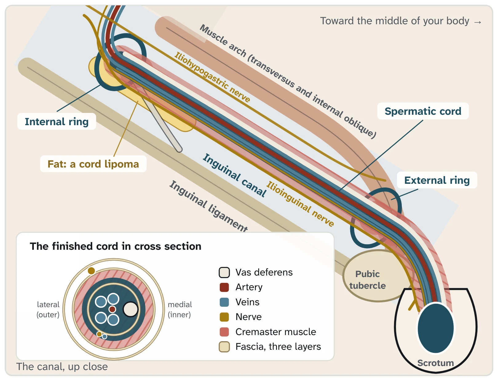 Close-up drawing of the inguinal canal on the right side. The spermatic cord runs from the internal ring, along the canal, out the external ring and down to the testicle in the scrotum. An inset shows the cord cut across: the vas deferens and a small artery with veins close around it, a nerve with a small vein beside it, deep to the cremaster muscle and outside the thin fascia around the vessels, and a second nerve just outside the cremaster. Three thin fascial layers wrap the cord. The lateral (outer) side is on the left and the medial (inner) side is on the right.