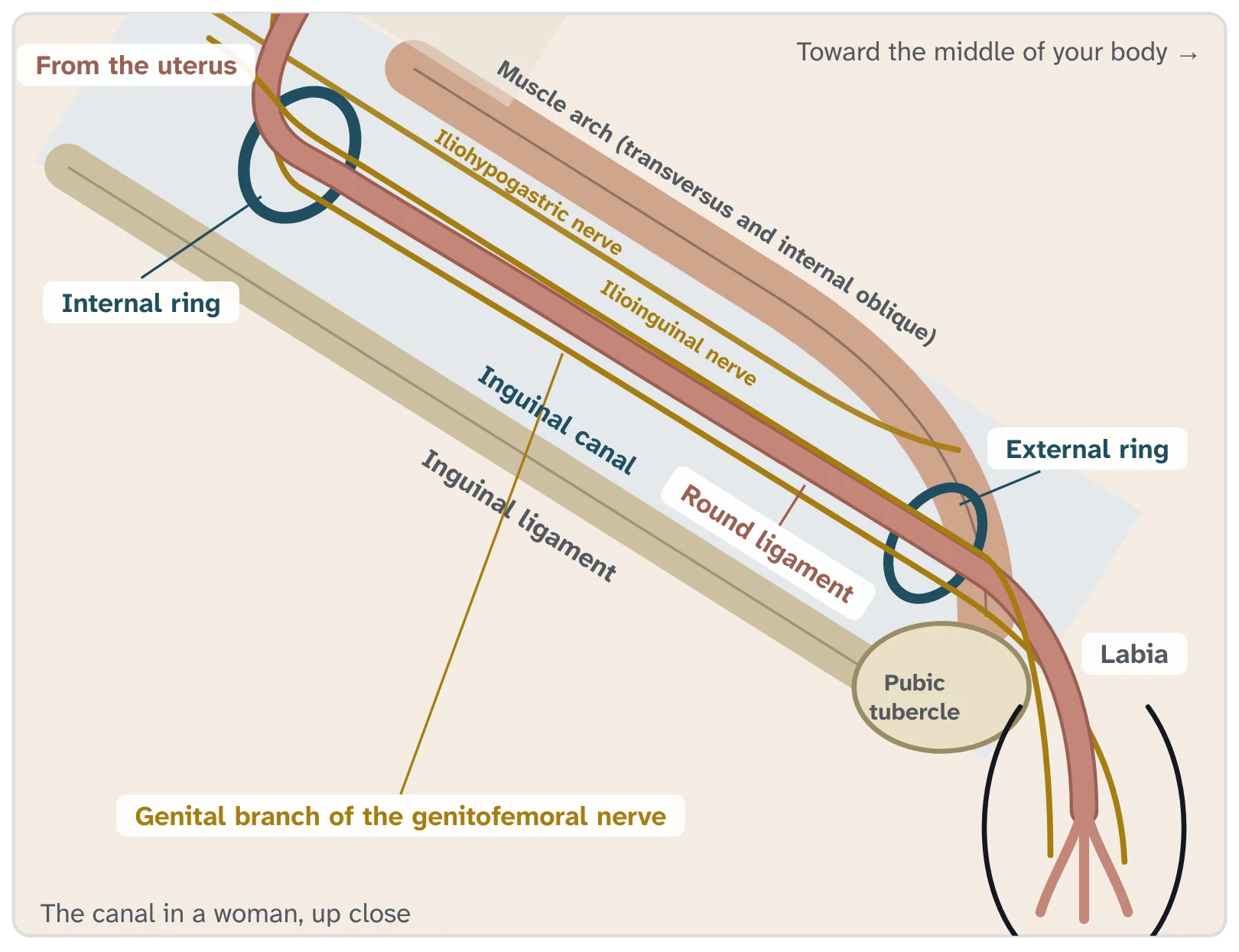 Close-up drawing of the inguinal canal in a woman, right side. The round ligament comes down from the uterus, passes through the internal ring, runs along the canal, leaves through the external ring and fans out into the labia. A thin nerve, the genital branch of the genitofemoral nerve, runs beside it. A second nerve, the iliohypogastric nerve, runs above the canal, below the muscle arch. A third nerve, the ilioinguinal nerve, comes through the muscle wall beside the internal ring, runs along the canal and leaves through the external ring.