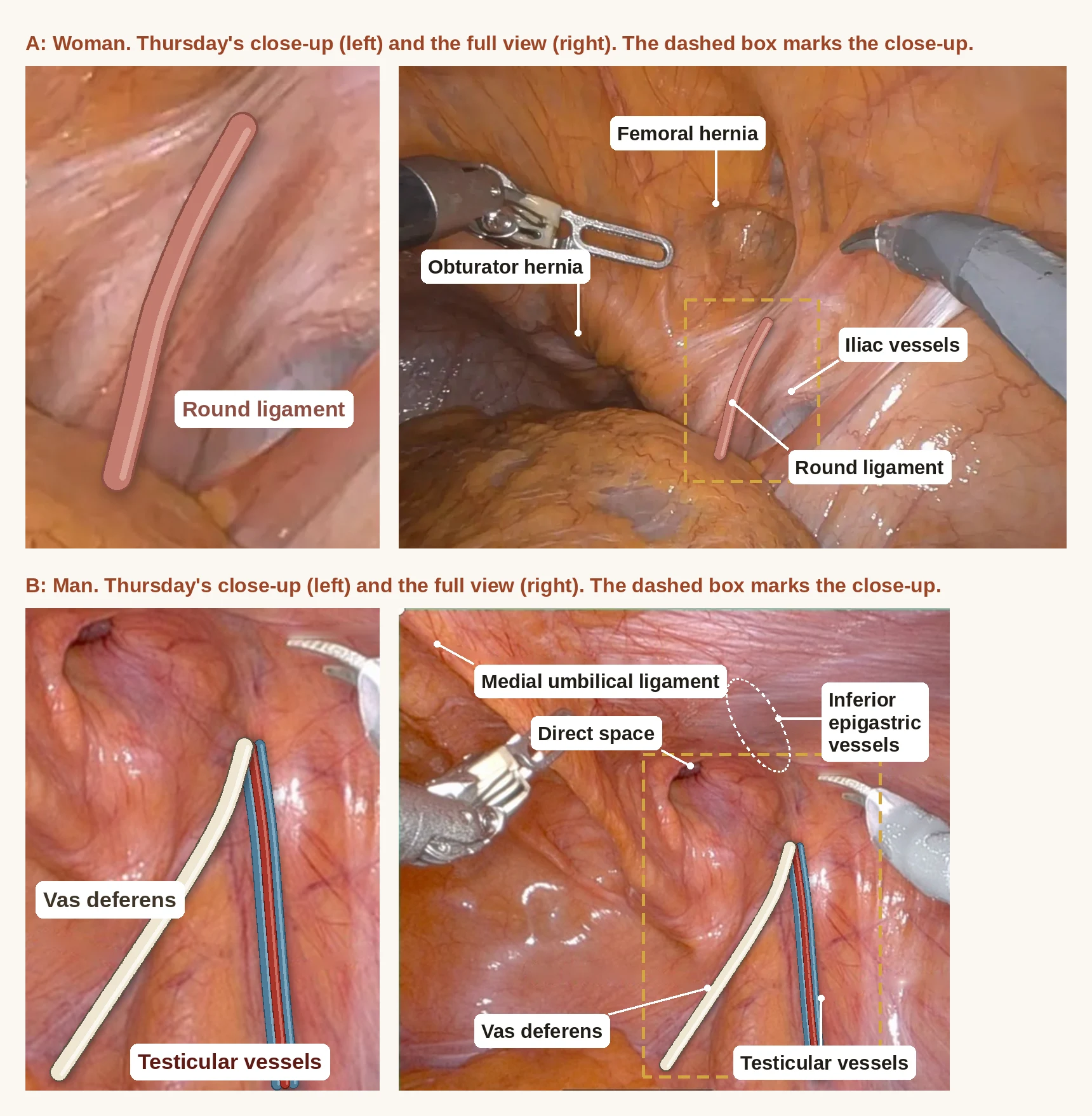 Two rows of photos from inside the abdomen during robotic surgery. Top, a woman: Thursday's close-up with the round ligament drawn in, beside the full view labeled femoral hernia, obturator hernia, iliac vessels and round ligament. Bottom, a man: the close-up with the vas deferens and testicular vessels drawn in, beside the full view labeled medial umbilical ligament, direct space, inferior epigastric vessels, vas deferens and testicular vessels.
