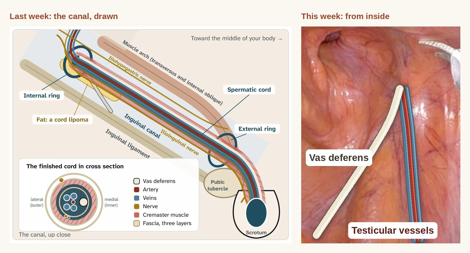 Left, last week's drawing of the inguinal canal in a man with the spermatic cord running through it. Right, the robotic view of a man's internal ring with the vas deferens and testicular vessels drawn in the same colors, meeting in a V.