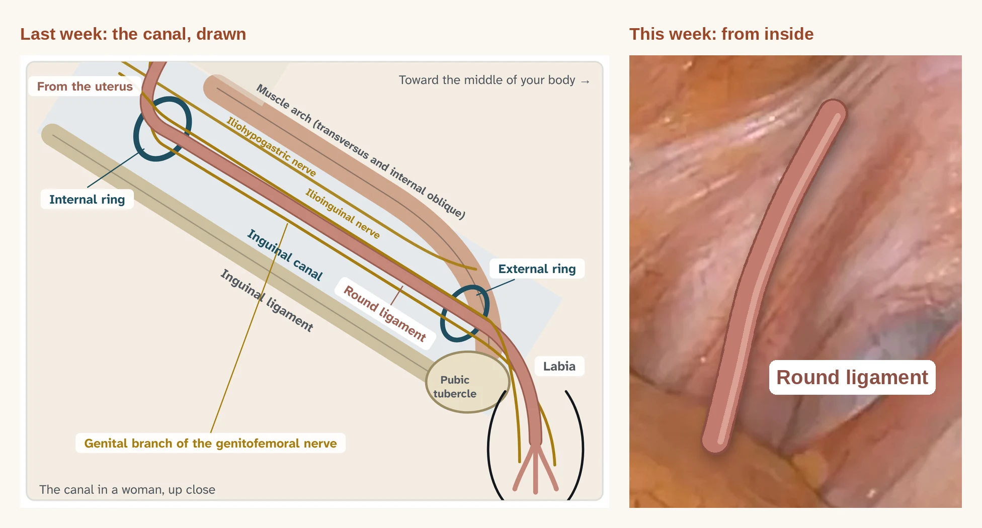 Left, last week's drawing of the inguinal canal in a woman with the round ligament running through it. Right, the robotic view of a woman's internal ring with the round ligament drawn in the same color.