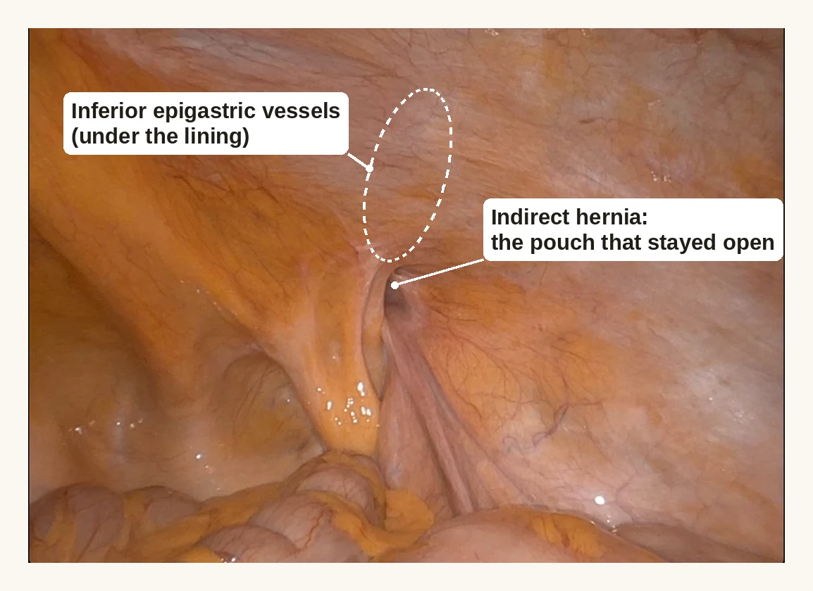 Robotic view from inside the abdomen of a man's internal ring with an open pouch, an indirect inguinal hernia. A dotted oval marks where the inferior epigastric vessels lie under the lining.