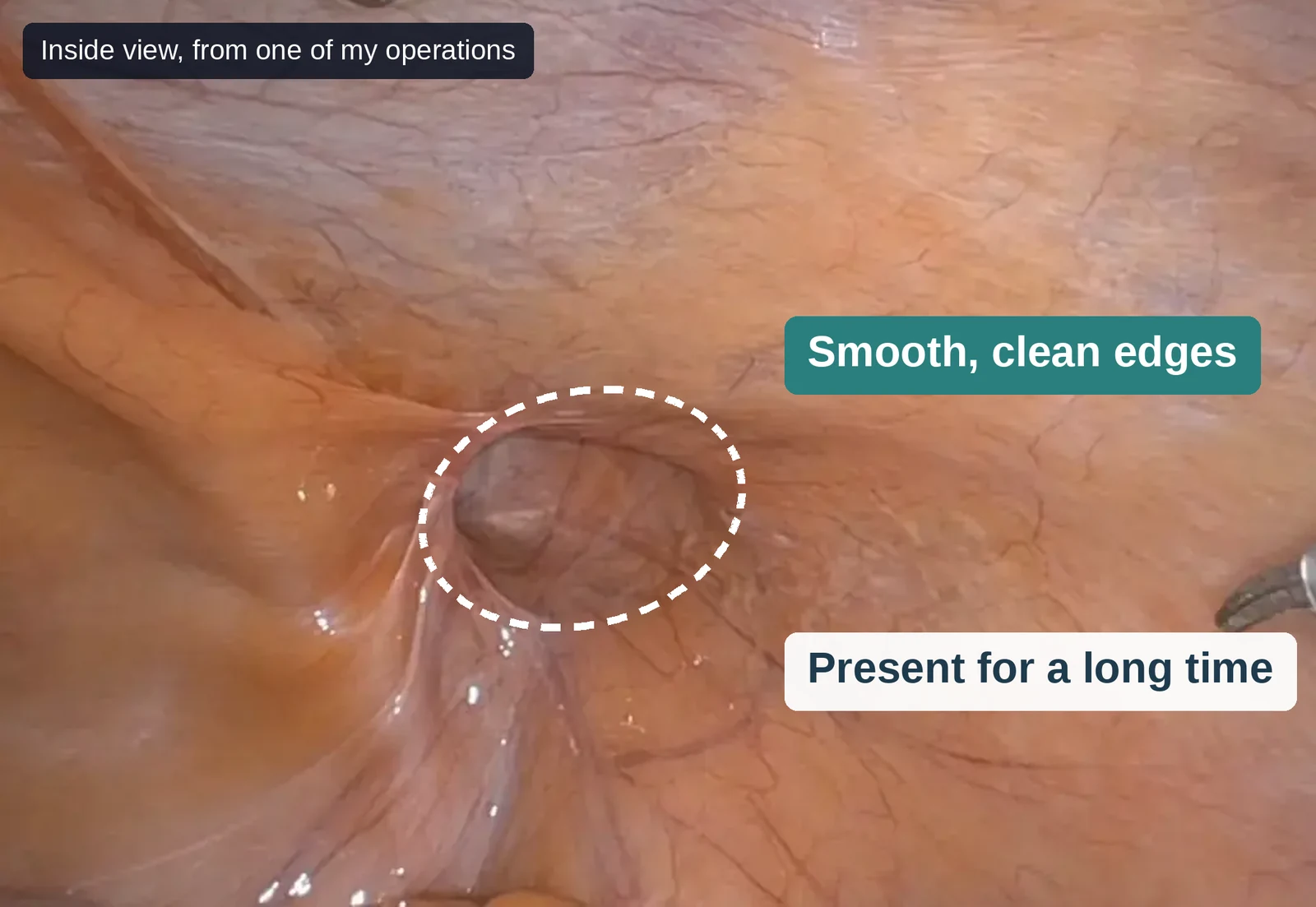 Photo from inside the abdomen during one of my operations. A dashed oval circles the opening of an indirect inguinal hernia, labeled smooth, clean edges and present for a long time.