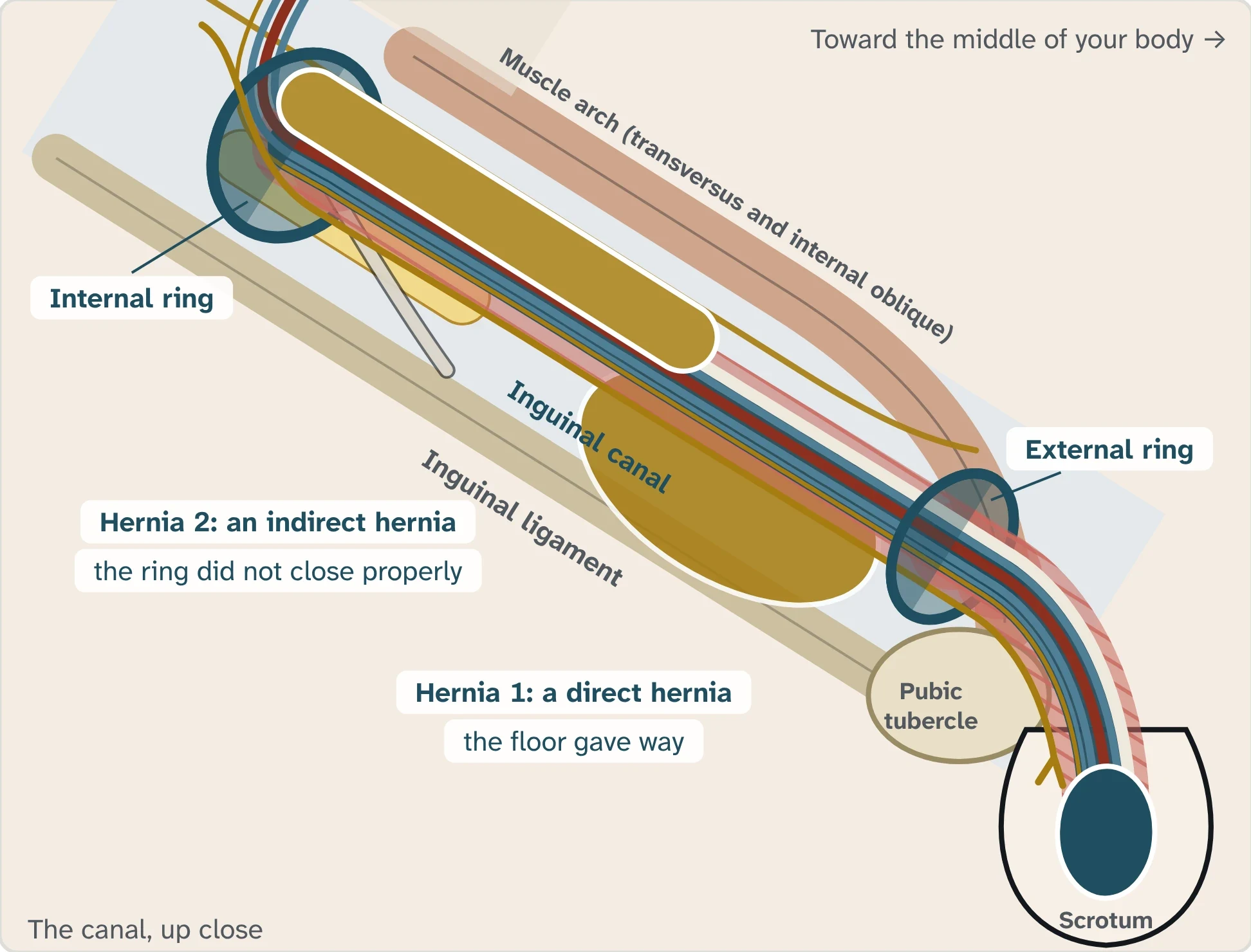 Drawing of the inguinal canal in a man, seen from the front, marking the two places a hernia can form: the internal ring and the floor of the canal.