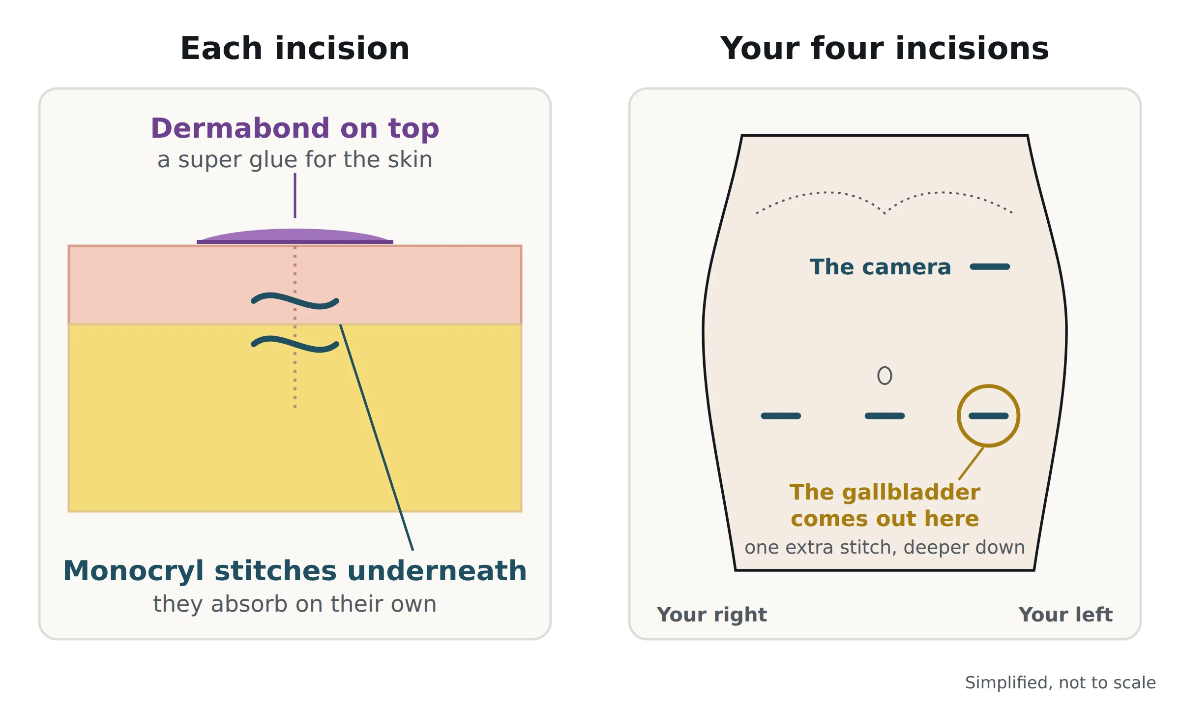 Left: a cross-section of one incision, with surgical glue on top of the skin and dissolving stitches underneath. Right: the four incisions, with the camera incision high on the left side and three across the abdomen near the navel. The one to the left of the navel is circled: the gallbladder comes out here, with one extra stitch deeper down.