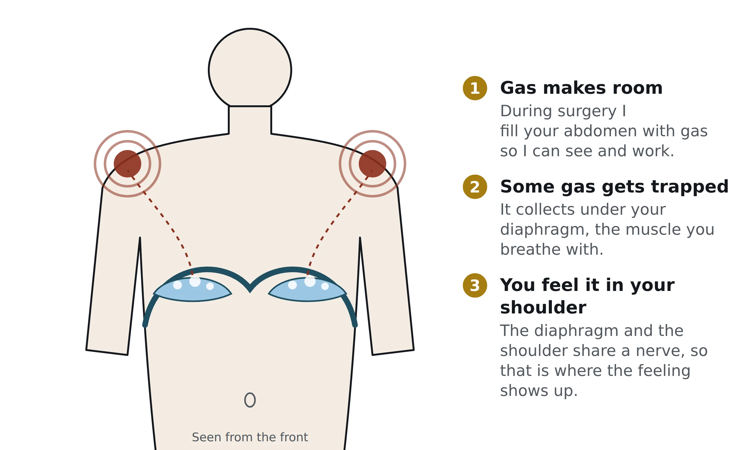 Front view of the upper body. Gas bubbles sit under the diaphragm on both sides, with dotted lines running up to the shoulders, which are marked as the place the pain is felt. Three steps: gas makes room, some gas gets trapped under the diaphragm, and you feel it in your shoulder because the two share a nerve.