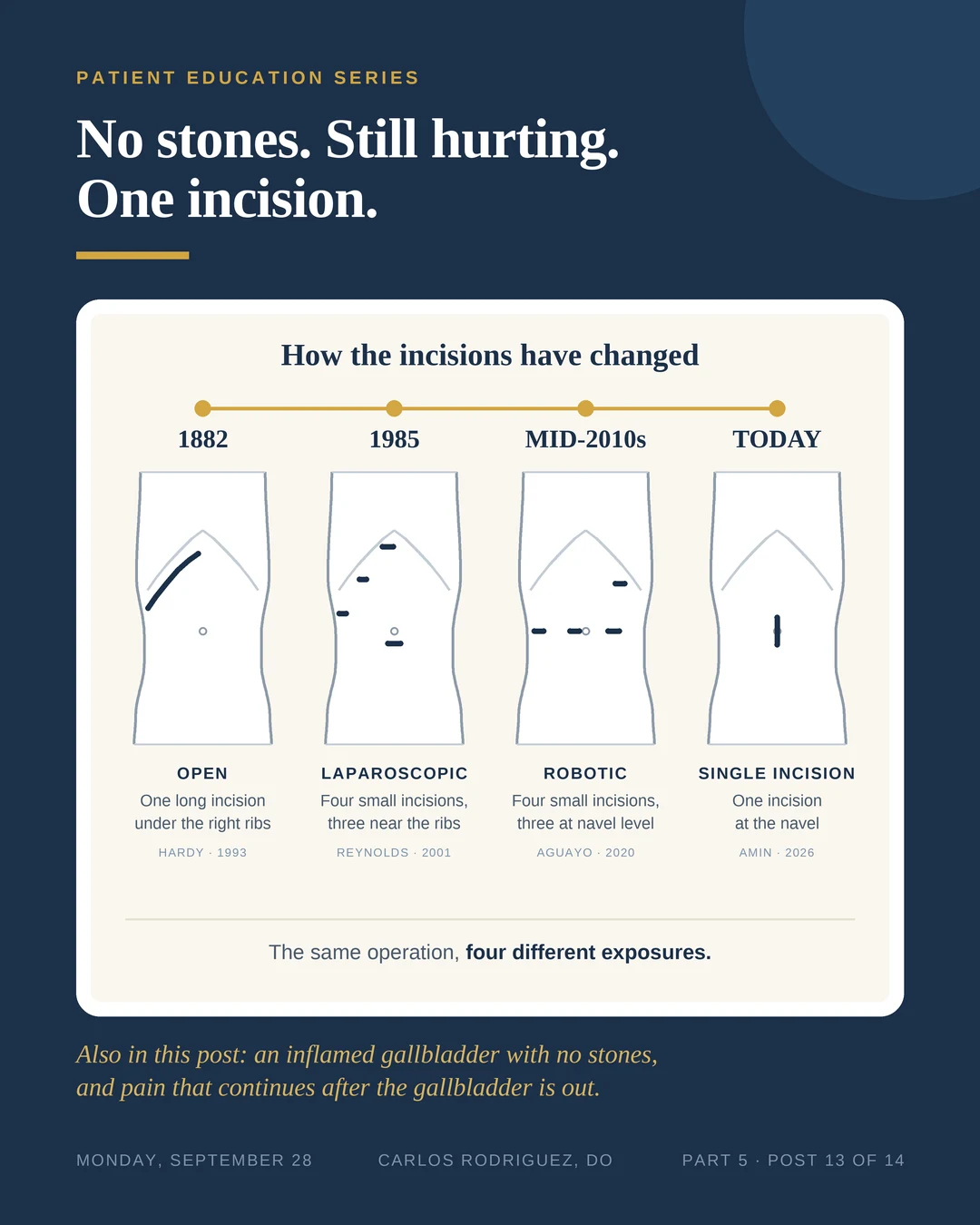 Four simple drawings of the abdomen on a timeline. 1882, open surgery: one long incision under the right ribs. 1985, laparoscopic surgery: four small incisions, three near the ribs and one at the navel. Mid-2010s, robotic surgery: four small incisions, three at navel level and one under the left ribs. Today, single incision: one incision at the navel.