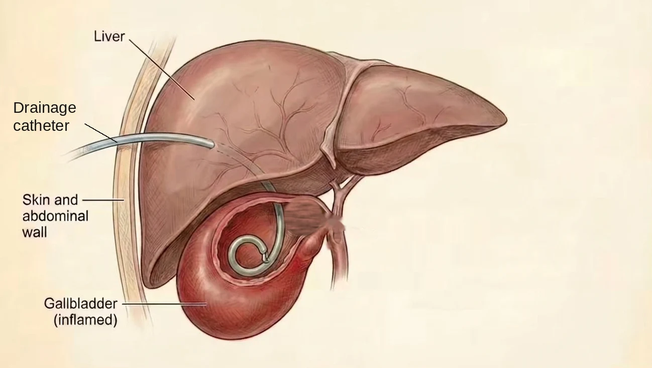 Drawing of a drain placed through the skin and abdominal wall, through the edge of the liver, into an inflamed gallbladder. The tip of the drain is coiled inside the gallbladder so it stays in place.
