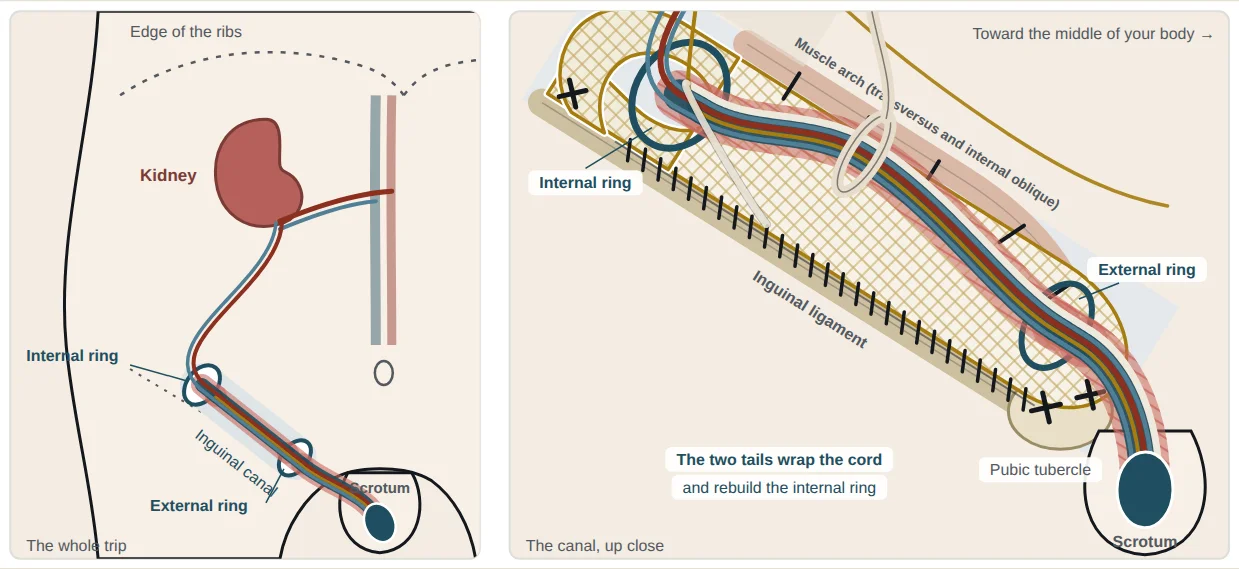 The finished open repair: mesh on the floor of the inguinal canal, under the spermatic cord, with its two tails wrapped around the cord.