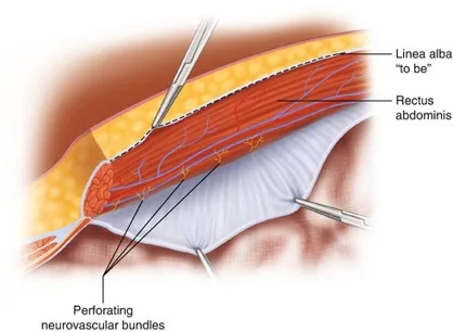 Diagram of abdominal wall layers showing mesh placement options