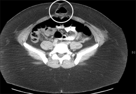 CT scan showing an abdominal wall hernia