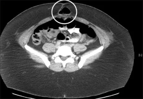 CT scan showing an abdominal wall hernia