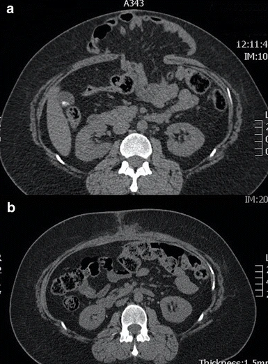 Before and after CT scans showing a large hernia repair