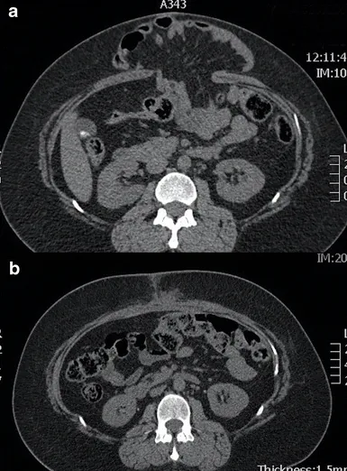 Before and after CT scans showing a large hernia repair